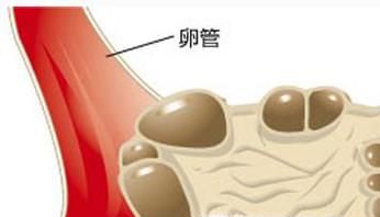 多囊卵巢综合症怎样治疗？