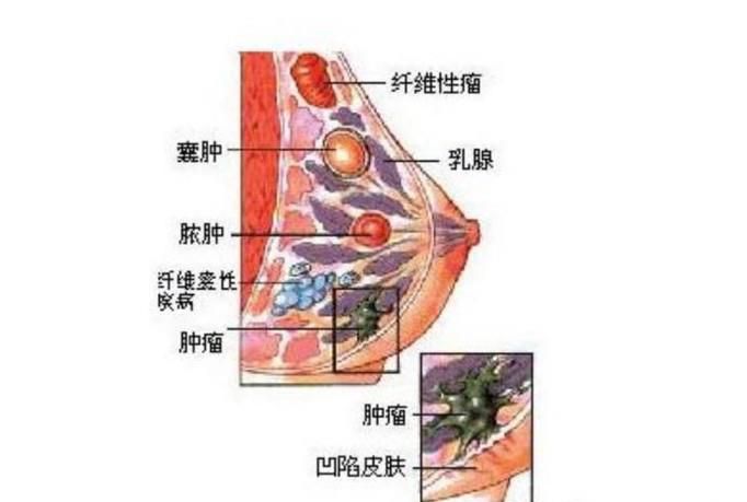 什么是乳腺癌 乳腺癌有哪些症状