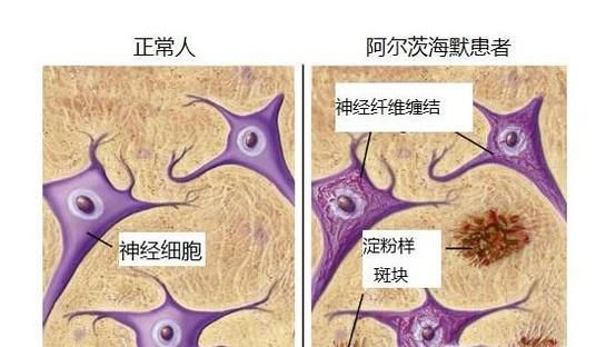 盘点阿尔兹海默症的十大早期症状