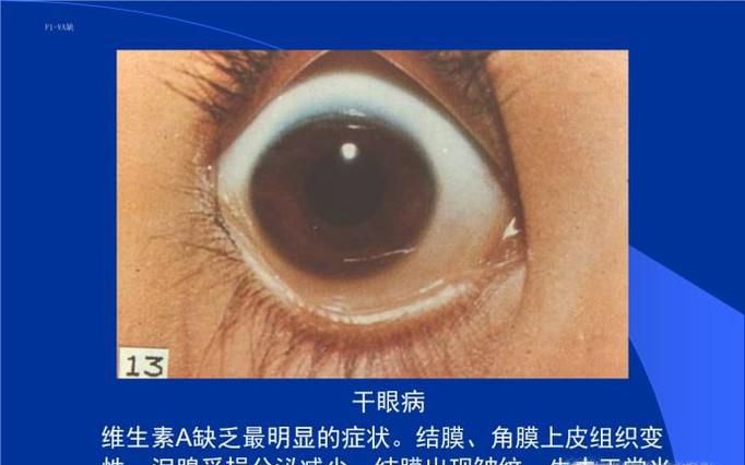 干眼症用什么眼药水