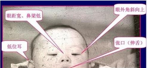 唐氏综合症都有哪些临床表现？