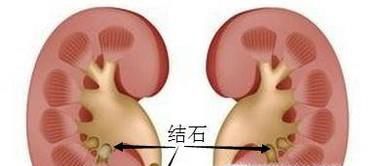 常喝饮料为什么会患肾结石