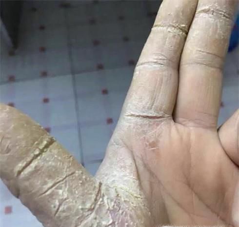 鹅掌风如何治疗