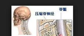 做颈椎牵引有什么好处