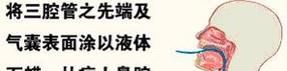 三腔二囊管止血法