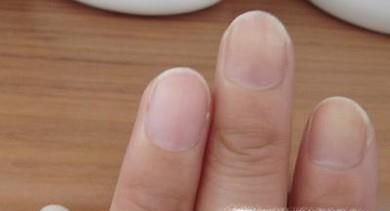 玉之甲为你讲解治疗灰指甲的小偏方
