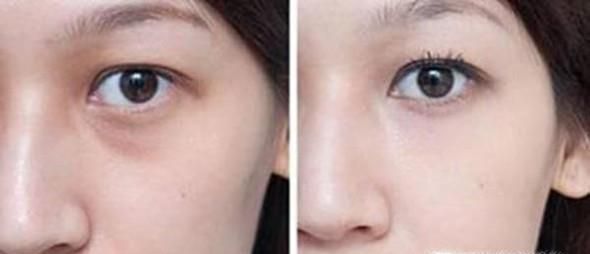 做去眼袋失败修复安全吗