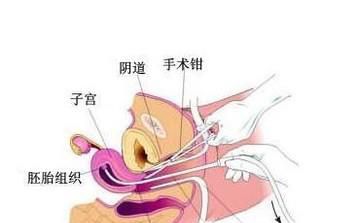 最适合女性做无痛人流的最佳时间