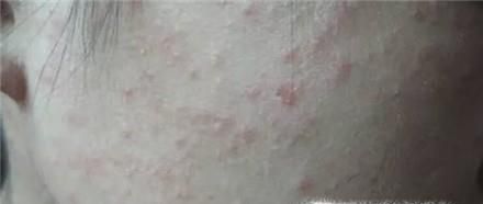 如何识别HIV疹