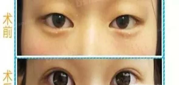 北京韩式双眼皮去哪家医院好？