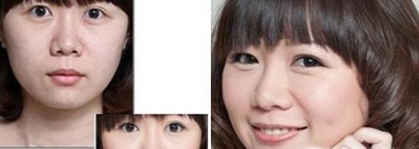 自体脂肪丰苹果肌做完要多久时间？