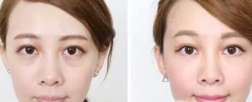 全切法去眼袋做完要多久时间？