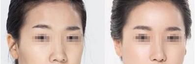 玻尿酸丰面颊做完要多久时间？