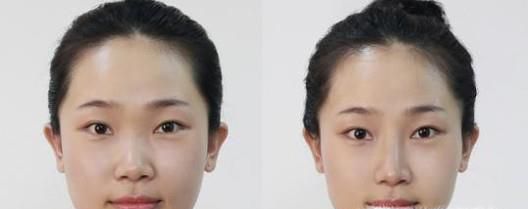 颧骨降低做完要多久时间？