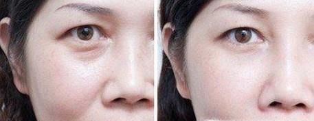 丰脸颊做完要多久时间？