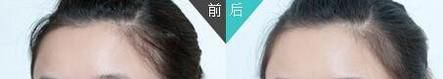 玻尿酸填充泪沟做完要多久时间？