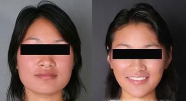 颊脂肪垫切除瘦脸做完要多久时间？
