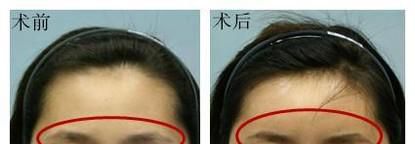 眉弓再造术做完要多久时间？