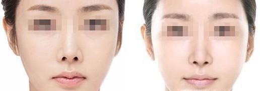 自体脂肪垫下巴做完要多久时间？