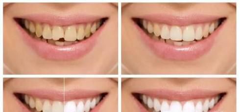 四环素牙美白做完要多久时间？