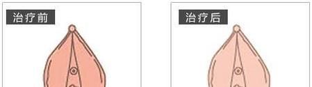 阴唇漂红手术缺点有哪些？