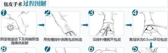 包茎手术效果好不好？