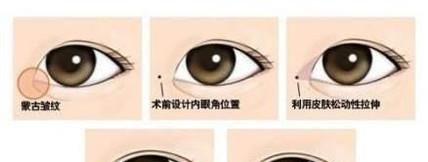 做韩式开眼角时间是多久？