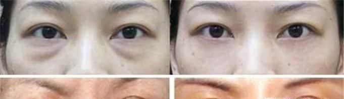 做射频消融去眼袋时间是多久？