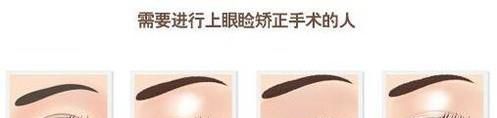 做额部悬吊矫正上睑下垂时间是多久？