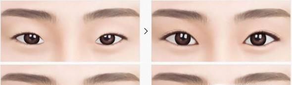 开眼角失败修复做完要多久时间？
