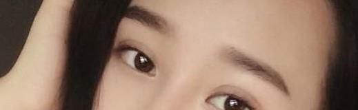 做欧式双眼皮手术麻醉方式是什么？
