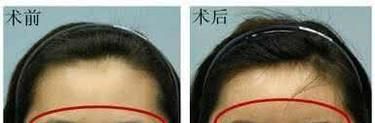 做隆眉弓失败修复手术麻醉方式是什么？