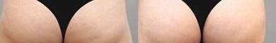激光溶脂瘦大腿手术缺点有哪些？