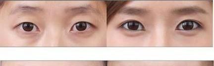 做韩式开眼角手术麻醉方式是什么？