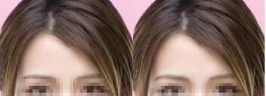 做去卧蚕手术麻醉方式是什么？