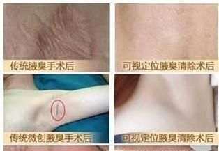 去狐臭手术效果好不好？