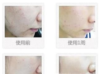 光子去痘印手术效果好不好？