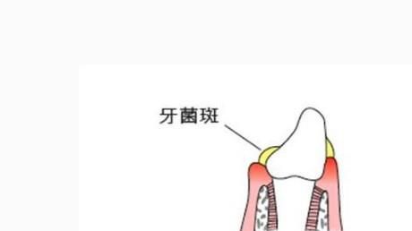 孩子牙齿上有菌斑怎么办？