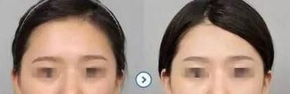 天津面部脂肪填充去哪家医院好？