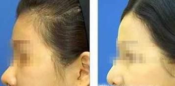 天津哪家医院面部吸脂好？