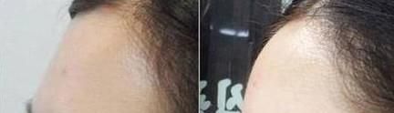 广州哪家医院做丰额头好？