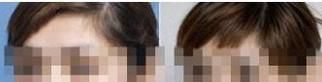 广州哪家医院面部脂肪填充好？