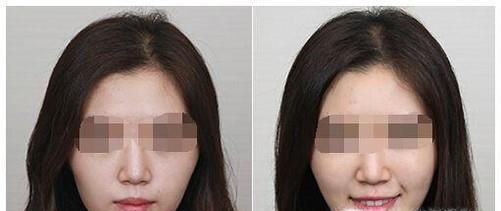玻尿酸打苹果肌禁忌人群有哪些