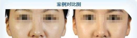 玻尿酸打太阳穴手术前后应该注意什么