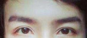 杭州男生开双眼皮多少钱