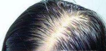 症状性脱发怎么治疗