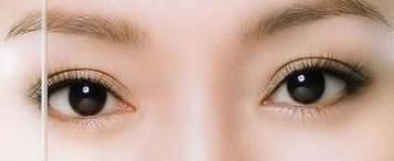 杭州单眼皮做双眼皮价格