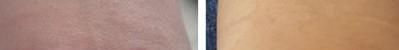 去疤激光效果好不好