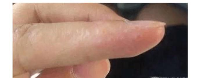 手上出现密密麻麻的小水泡怎么办