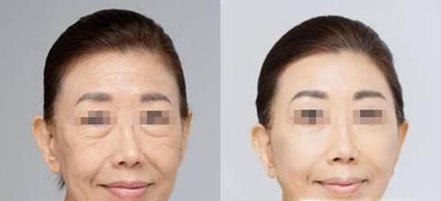 面部提升价格